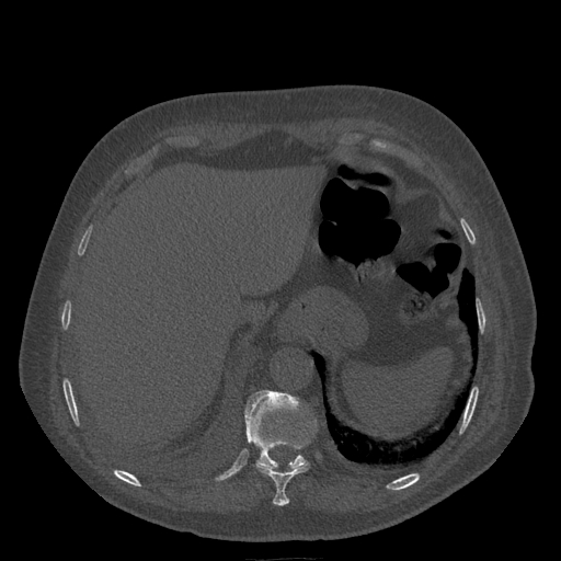 Bronchogenic carcinoma with metastatic lymphadenopathy (Radiopaedia 37671-39569 Axial bone window 48).jpg