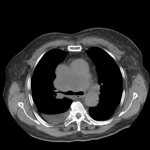 File:Bronchogenic carcinoma with metastatic lymphadenopathy (Radiopaedia 37671-39569 Axial non-contrast 22).jpg
