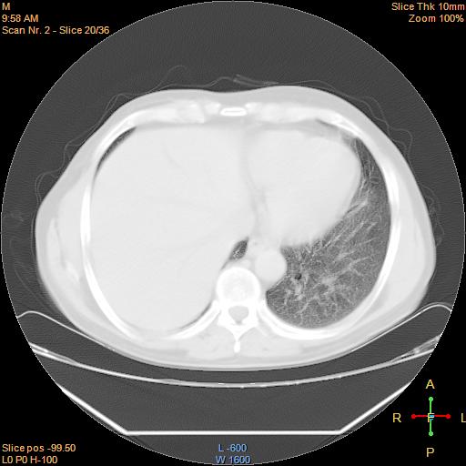 File:Bronchogenic carcinoma with superior vena caval invasion (Radiopaedia 22378-22406 lung window 17).jpg