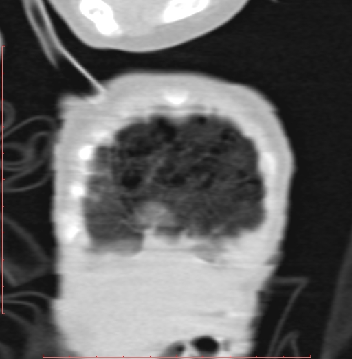 Bronchogenic cyst (Radiopaedia 78599-91409 Coronal lung window 22).jpg