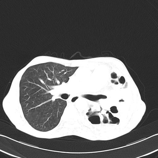 Bronchopleural fistula secondary to tuberculosis (Radiopaedia 20415-20322 Axial lung window 27).jpg
