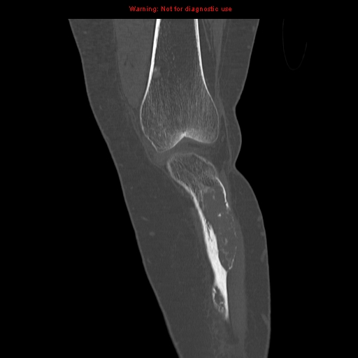 File:Brown tumors (Radiopaedia 9666-10291 Coronal bone window 7).jpg