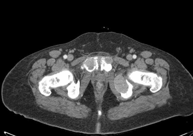 Brown tumors compressing the spinal cord (Radiopaedia 68442-77988 E 126).jpg
