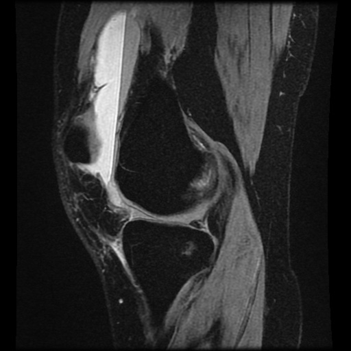 Bucket handle meniscus tear (Radiopaedia 56916-63751 H 54).jpg