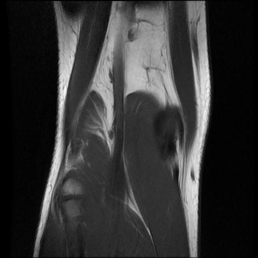 File:Bucket handle tear - lateral meniscus (Radiopaedia 72124-82634 Coronal T1 15).jpg