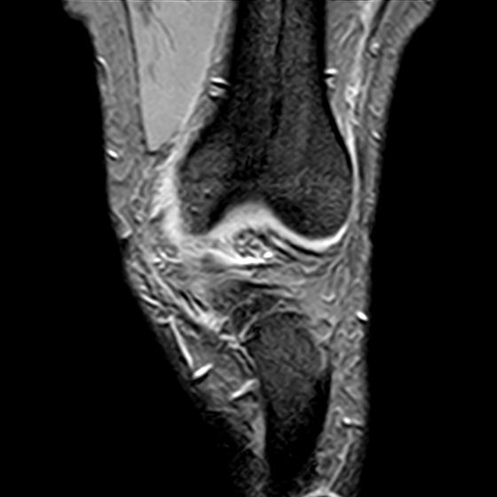 File:Bucket handle tear - medial meniscus (Radiopaedia 29250-29664 B 3).jpg