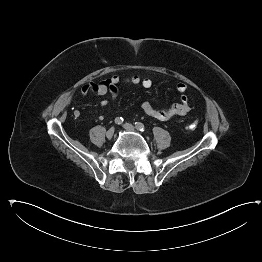 Buried bumper syndrome - gastrostomy tube (Radiopaedia 63843-72577 Axial Inject 83).jpg