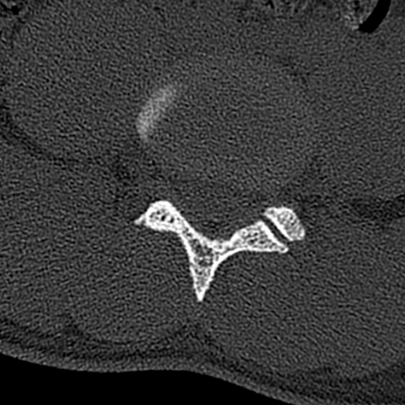 Burst fracture (Radiopaedia 53373-59357 Axial bone window 51).jpg