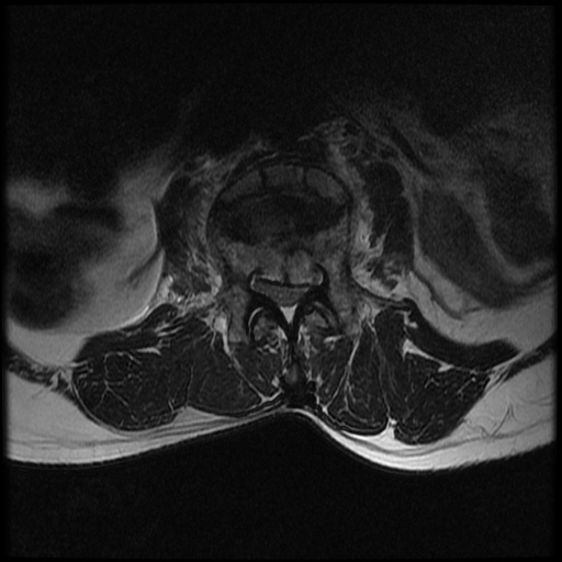 File:Burst fracture - lumbar spine (Radiopaedia 72877-83541 Axial T2 8).jpg