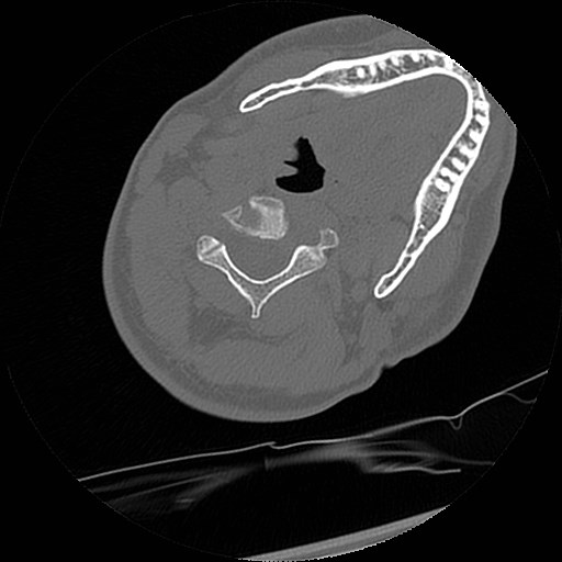 C1-C2 "subluxation" - normal cervical anatomy at maximum head rotation (Radiopaedia 42483-45607 Axial non-contrast 30).jpg