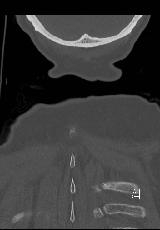 C1 and C2 (peg) fractures (Radiopaedia 36618-38184 Coronal bone window 56).jpg