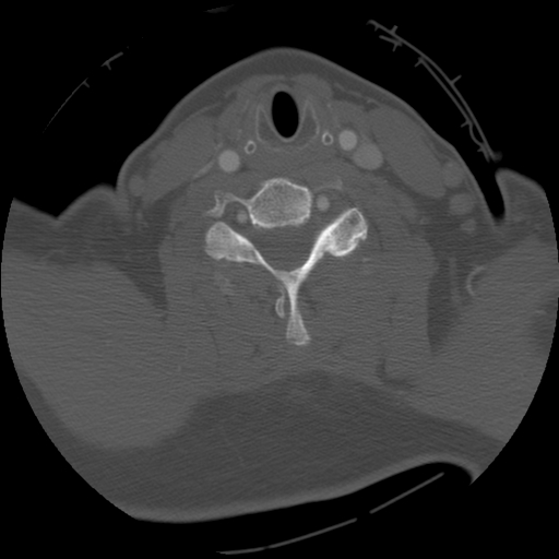 File:C1 anterior arch (plough) fracture - type 1 (Radiopaedia 76181-87720 Axial bone window 55).jpg