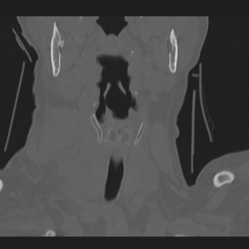 C2 fracture (Radiopaedia 34091-35341 Coronal bone window 3).png
