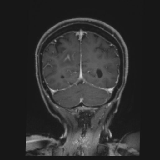 File:CNS lymphoma with steroid response (Radiopaedia 37980-39921 Coronal T1 C+ 39).png
