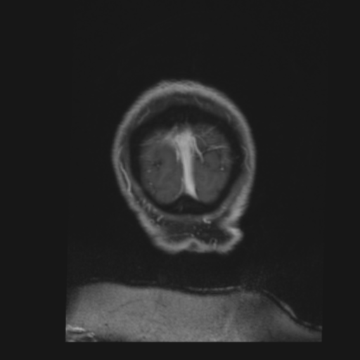 File:CNS lymphoma with steroid response (Radiopaedia 37980-39921 Coronal T1 C+ 51).png