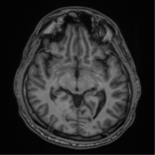 CNS vasculitis (Radiopaedia 55715-62263 Axial T1 19).png