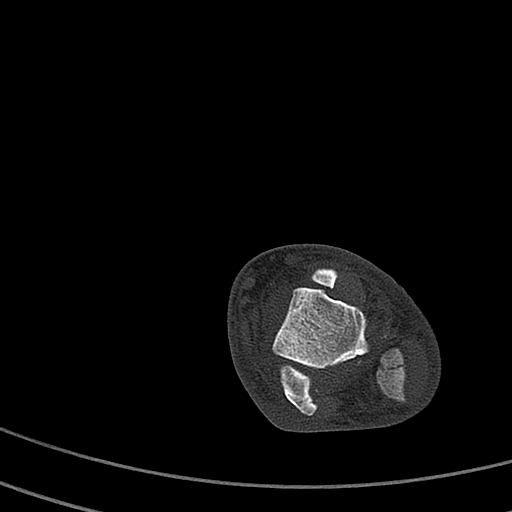 Calcaneal fracture - Sanders type 4 (Radiopaedia 90179-107370 Axial bone window 25).jpg