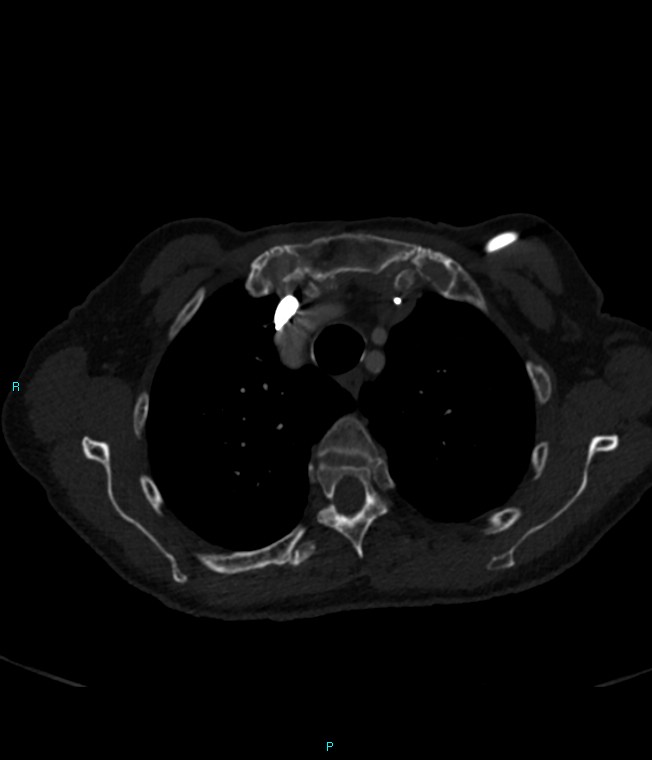 Calcified cerebral emboli from left ventricular thrombus (Radiopaedia 84420-99760 Axial bone window 16).jpg