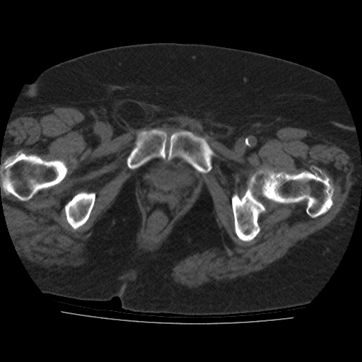 File:Calcified fibroids (Radiopaedia 16853-16579 non-contrast 17).jpg