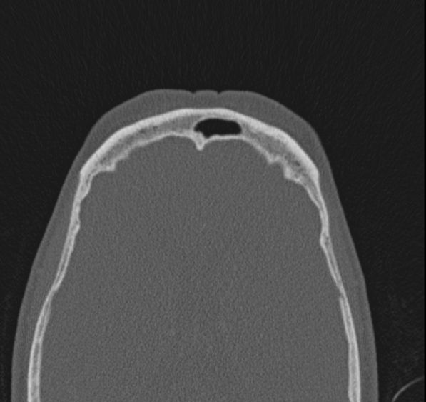 Caldwell-Luc operation (Radiopaedia 52329-58225 Axial bone window 11).jpg