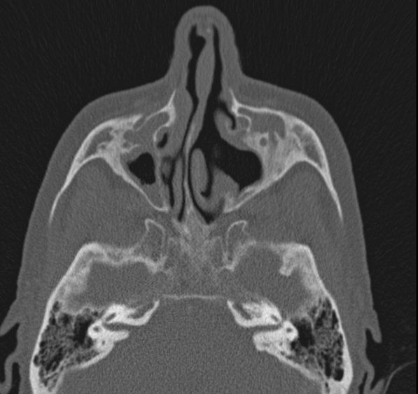Caldwell-Luc operation (Radiopaedia 52329-58225 Axial bone window 32).jpg