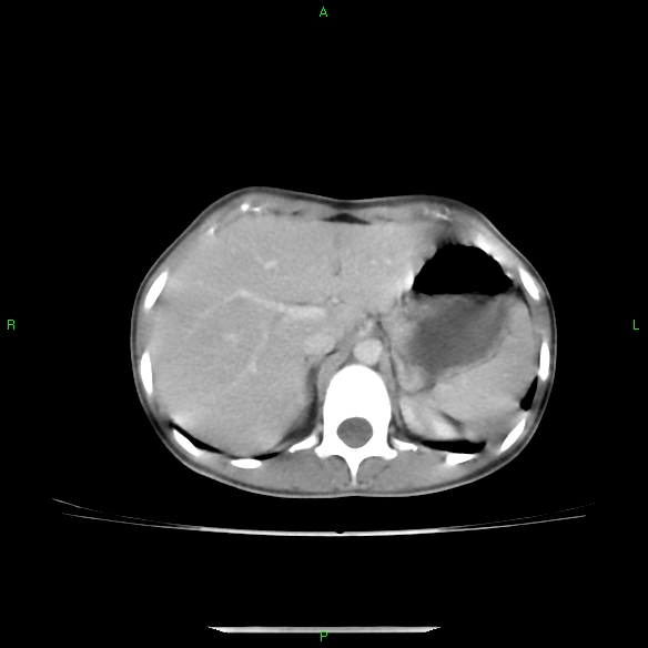 File:Cannon ball metastases - synovial sarcoma (Radiopaedia 26135-26271 C 36).jpg