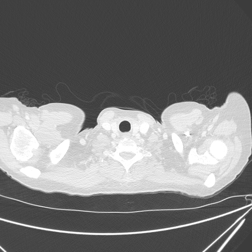 Canonball lung metastasis (Radiopaedia 77634-89837 Axial lung window 2).jpg