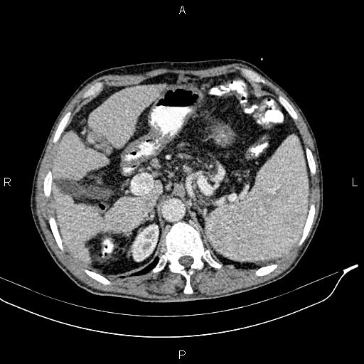 File:Caput medusae sign - portal hypertension (Radiopaedia 64007-72759 A 19).jpg