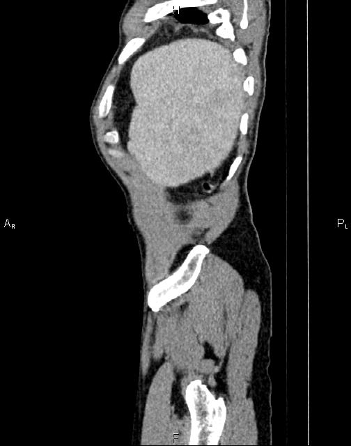 Caput medusae sign - portal hypertension (Radiopaedia 64007-72759 B 83).jpg