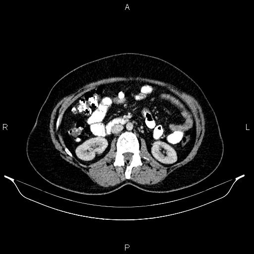 Carcinoma of uterine cervix (Radiopaedia 85861-101700 A 46).jpg