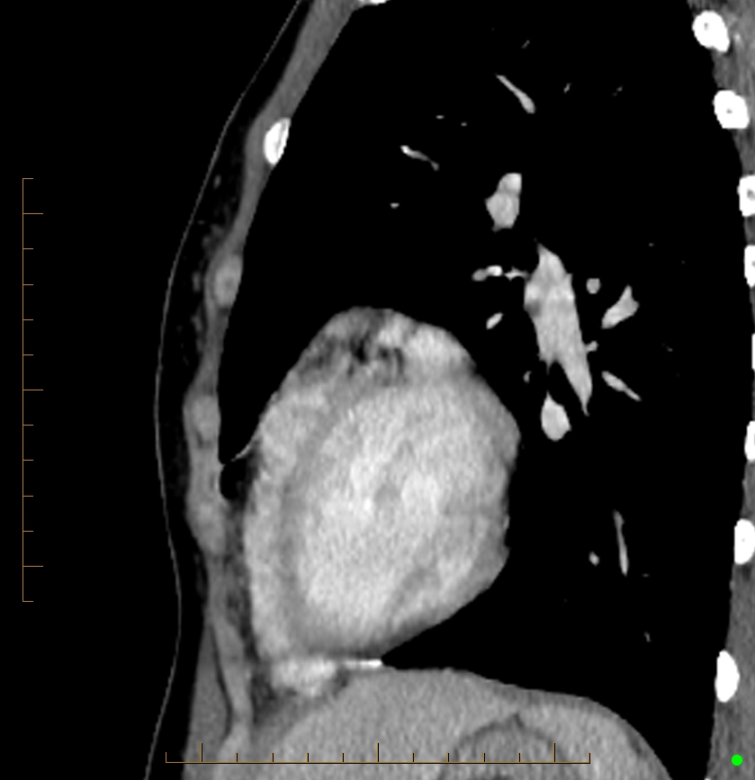 Cardiac paraganglioma (Radiopaedia 76345-88005 C 24).jpg