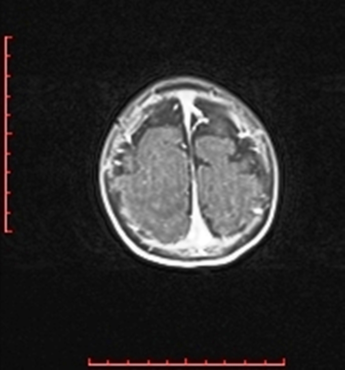 Cardiac rhabdomyoma - tuberous sclerosis (Radiopaedia 70089-80114 Axial T1 C+ fat sat 99).jpg