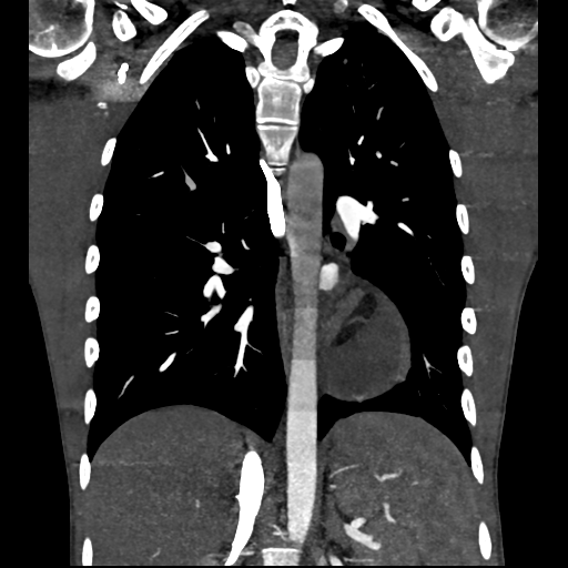 Cardiac tumor - undifferentiated pleomorphic sarcoma (Radiopaedia 45844-50134 Coronal non-contrast 44).png