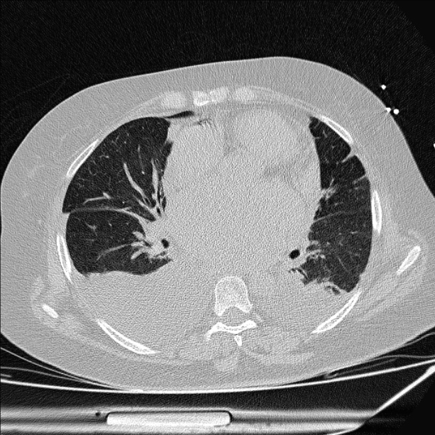Cardiogenic pulmonary edema (Radiopaedia 29213-29609 Axial lung window 54).jpg