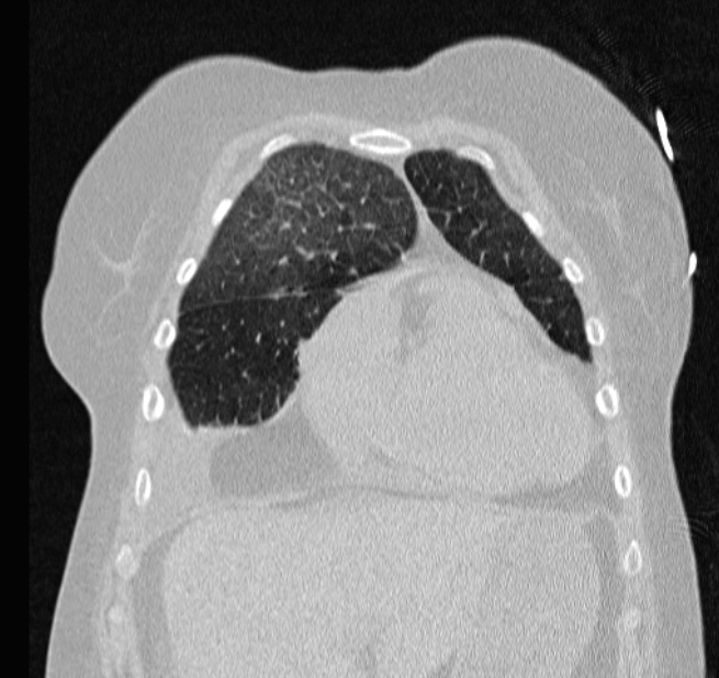 Cardiogenic pulmonary edema (Radiopaedia 29213-29609 Coronal lung window 14).jpg