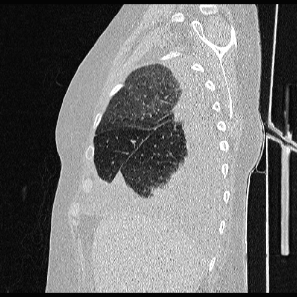 Cardiogenic pulmonary edema (Radiopaedia 29213-29609 Sagittal lung window 20).jpg