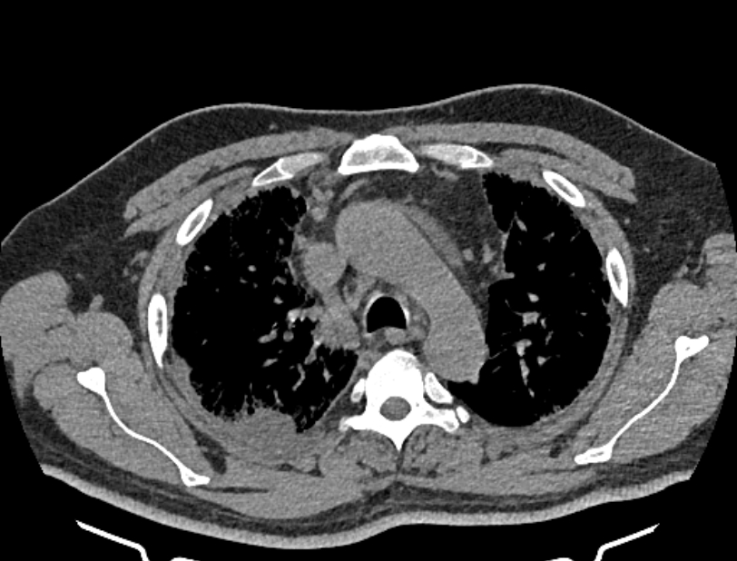 Cardiogenic pulmonary edema (Radiopaedia 68180-77678 Axial non-contrast 13).jpg