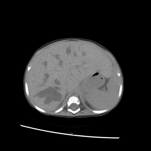 File:Caroli disease with autosomal recessive polycystic kidney disease (ARPKD) (Radiopaedia 89651-106703 Axial non-contrast 12).jpg