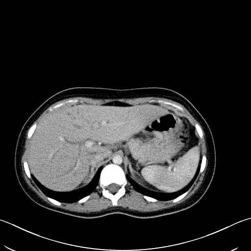 Caroli disease with medullary sponge kidney (Radiopaedia 82622-96804 C 19).jpg