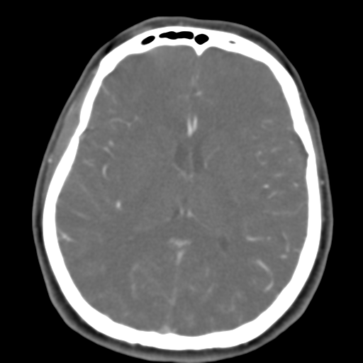 Carotico ophthalmic aneurysm (Radiopaedia 42916-46148 A 26).png