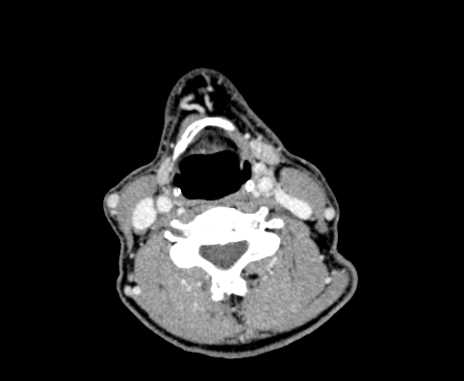 Carotid body tumor (Radiopaedia 61750-69757 Axial Post contrast 63).jpg