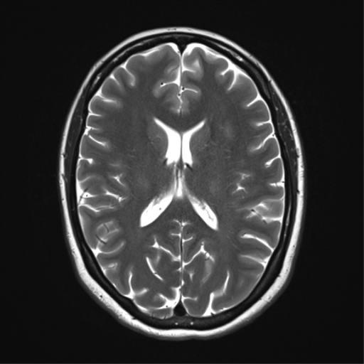 File:Cavernoma with bleed - midbrain (Radiopaedia 54546-60773 Axial T2 23).png