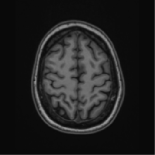 Cavernoma with bleed - midbrain (Radiopaedia 54546-60774 Axial T1 45).png