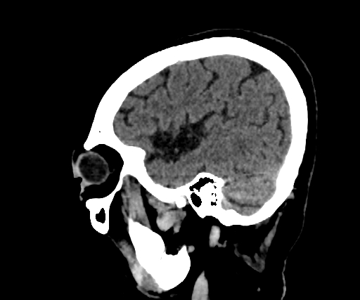 Cavernous hemangioma of the cerebellar falx (Radiopaedia 73025-83723 B 258).jpg