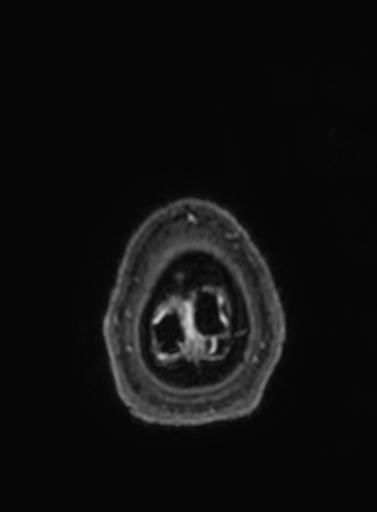 Cavernous hemangioma of the cerebellar falx (Radiopaedia 73025-83724 Axial T1 C+ 15).jpg