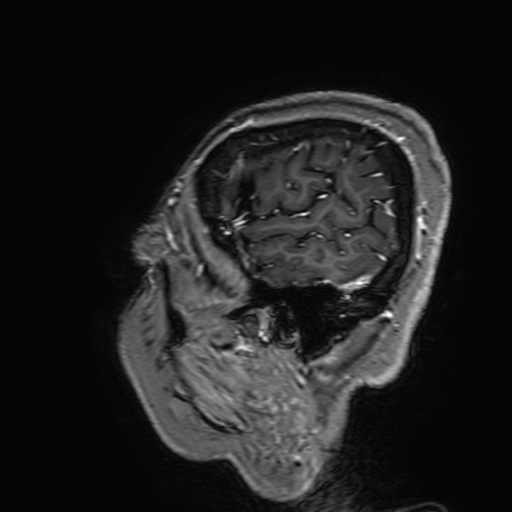 Cavernous hemangioma of the cerebellar falx (Radiopaedia 73025-83724 Sagittal T1 C+ 189).jpg