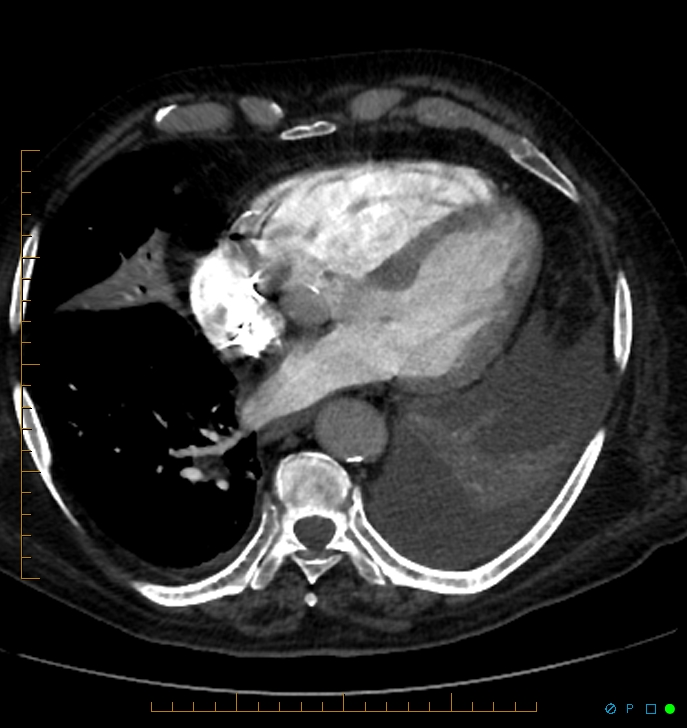 Cavitating pulmonary infarction (Radiopaedia 54634-60849 Axial C+ CTPA 57).jpg