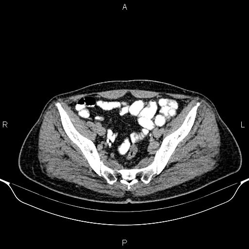 Cecal adenocarcinoma (Radiopaedia 85324-100916 Axial C+ delayed 82).jpg