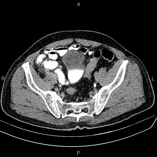 File:Cecal cancer with appendiceal mucocele (Radiopaedia 91080-108651 Axial C+ delayed 64).jpg