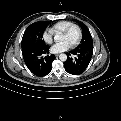 File:Cecal cancer with appendiceal mucocele (Radiopaedia 91080-108651 B 3).jpg